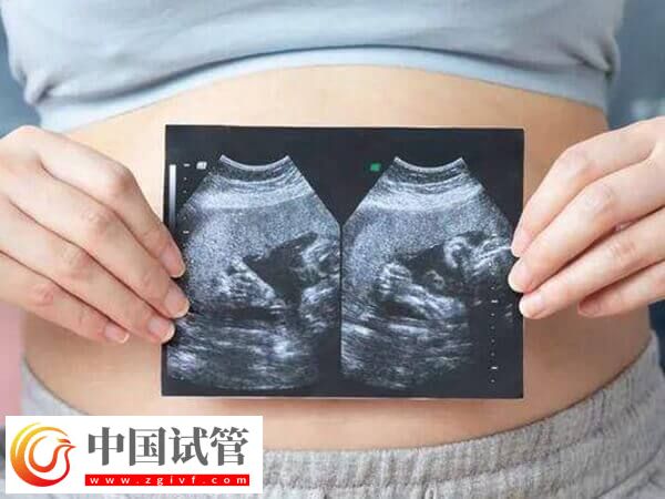 懷雙胞胎的產前準備有哪些(圖1)