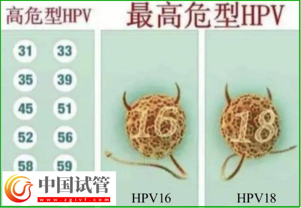 通過hpv報告單圖片怎么判斷自己是正常的呢?(圖3) 通過hpv報告單圖片怎么判斷自己是正常的呢?(圖3)