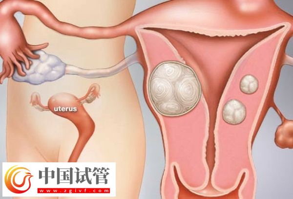 沒有子宮能生孩子嗎(圖1) 沒有子宮能生孩子嗎(圖1)