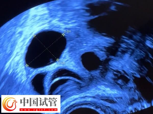 試管嬰兒促排卵期間多久做一次b超監測卵泡發育？(圖1)