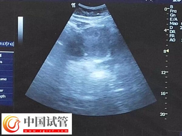 試管嬰兒詳細步驟一文總結，長方案助孕患者切莫錯過！(圖2)