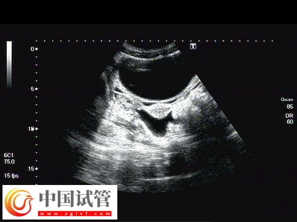 幼稚子宮無月經做試管嬰兒懷孕幾率低，移植難度大是其一(圖1)