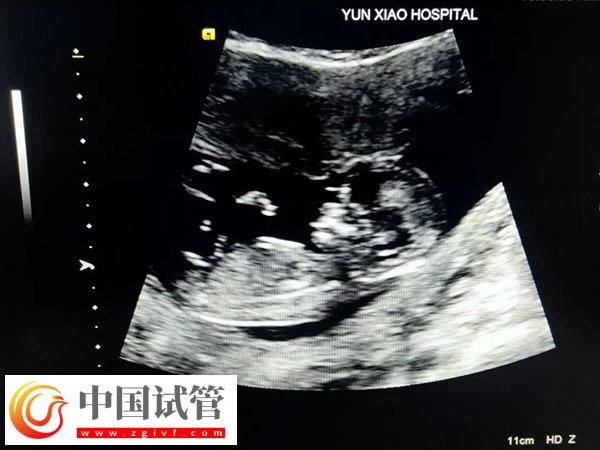 鄭州市婦幼保健院試管生男女費用(圖1)