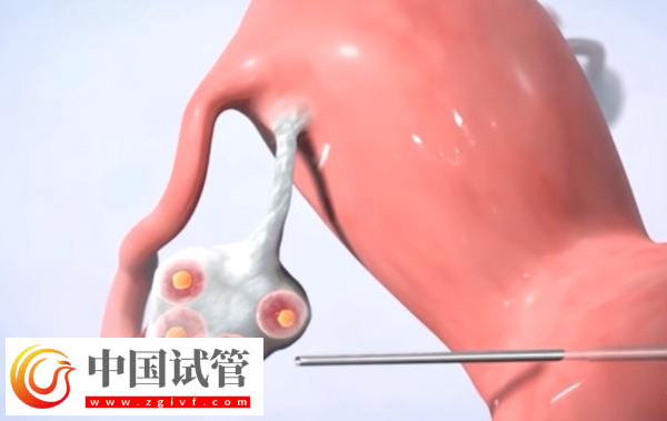 廣州凍卵是否合法(圖2)