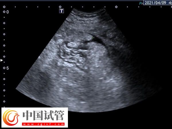 取卵腹水癥狀表現有哪些(圖1)