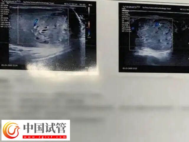 胚胎移植前如何調(diào)理內(nèi)膜(圖1)