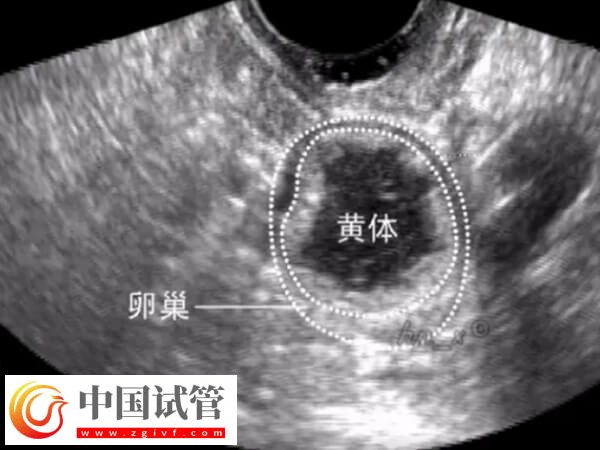 取卵后還有黃體殘留怎么辦(圖1) 取卵后還有黃體殘留怎么辦(圖1)