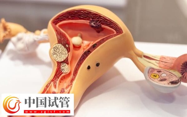 試管巧囊4cm影響著床(圖2)