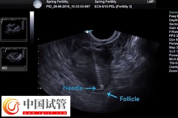 取卵后腹水怎么處理(圖1)