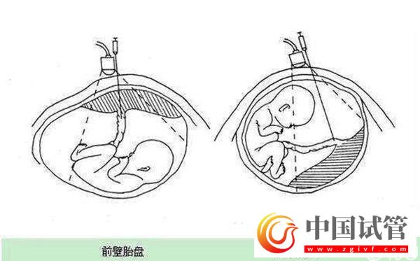 1分鐘了解胎盤前壁和后壁的3大區別，為孕期做好準備(圖1)