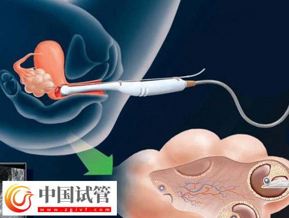 取卵手術要多少錢一次(圖1)
