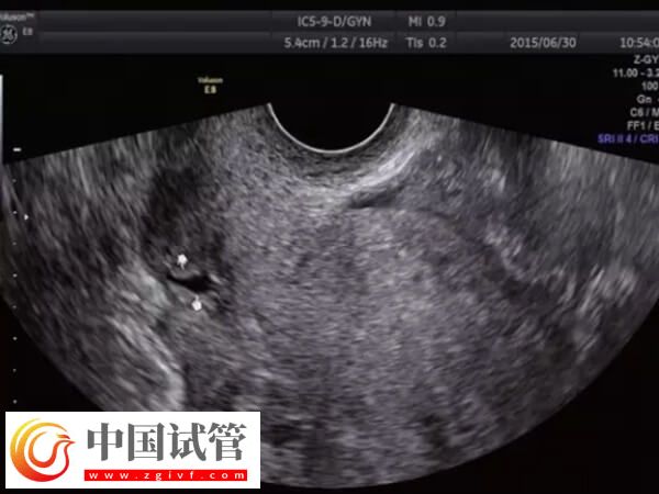 子宮憩室影不影響試管移植(圖1)