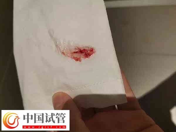 試管移植后有褐色血是不是生化了(圖1)