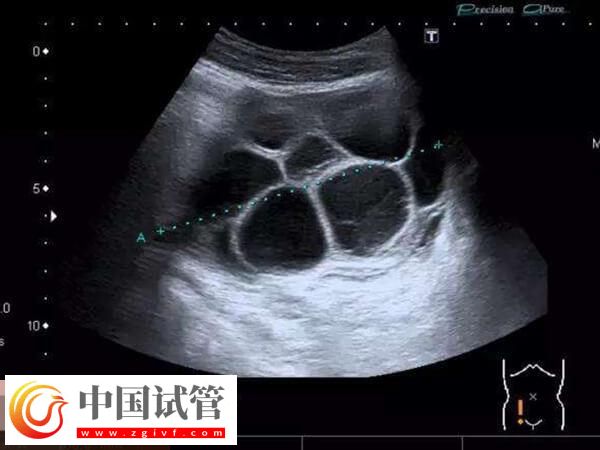 淺析移植完胚胎后為什么腹水，雌激素偏高或為主要因素(圖1)