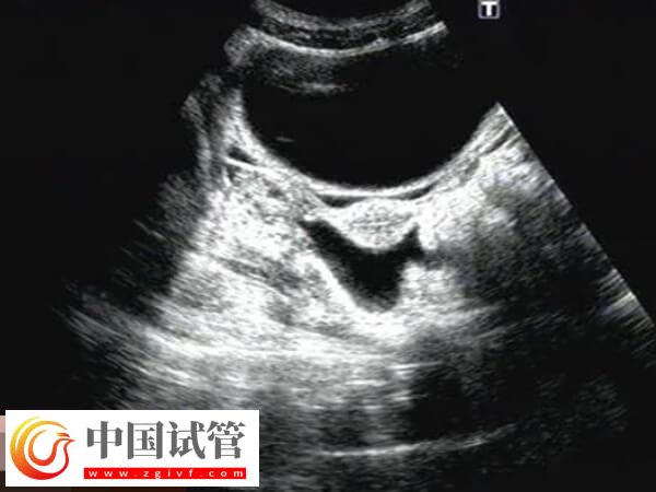 鮮胚移植后宮腔積液要注意，多久才能吸收一看便知(圖1)