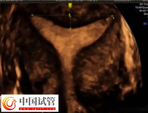 鮮胚移植后宮腔積液要注意，多久才能吸收一看便知(圖2)