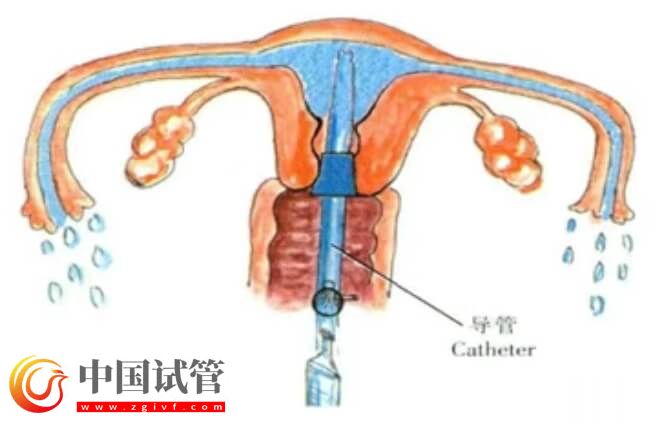 富血小板血漿PRP宮腔灌注后需注意3-7天內(nèi)禁止同房嗎?(圖1) 富血小板血漿PRP宮腔灌注后需注意3-7天內(nèi)禁止同房嗎?(圖1)