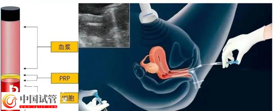 宮腔灌注具體的操作流程是怎么樣的?需要幾分鐘完成?(圖1) 宮腔灌注具體的操作流程是怎么樣的?需要幾分鐘完成?(圖1)