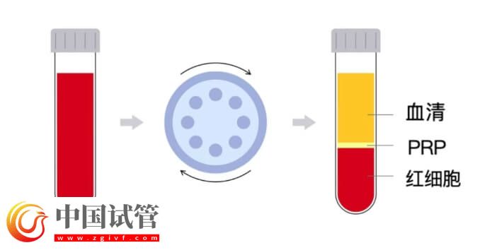 宮腔灌注PRP會增厚內(nèi)膜從而提高試管嬰兒成功率嗎?(圖1) 宮腔灌注PRP會增厚內(nèi)膜從而提高試管嬰兒成功率嗎?(圖1)