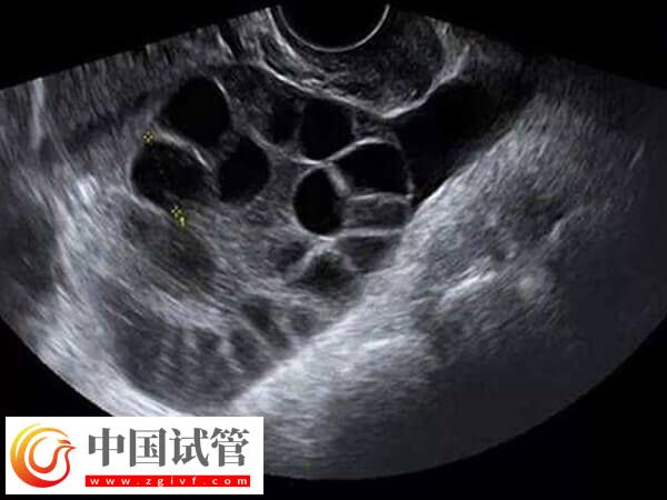 試管取卵對女性的卵泡也有要求，小于18mm一般還未發育成熟(圖1)