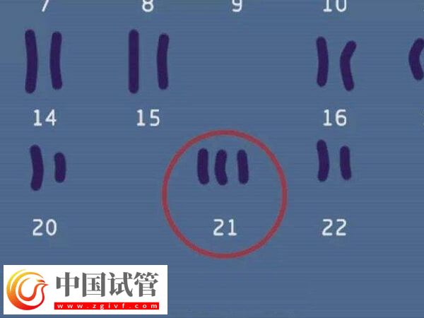 22號(hào)染色體異常還能不能要孩子(圖2) 22號(hào)染色體異常還能不能要孩子(圖1)