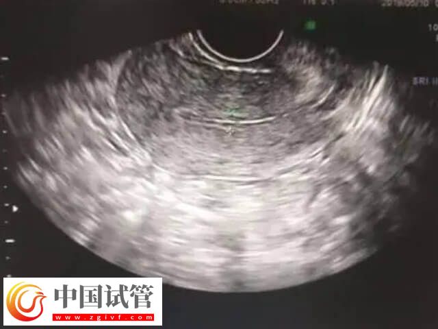 amh低于0.06還有沒有卵(圖2)