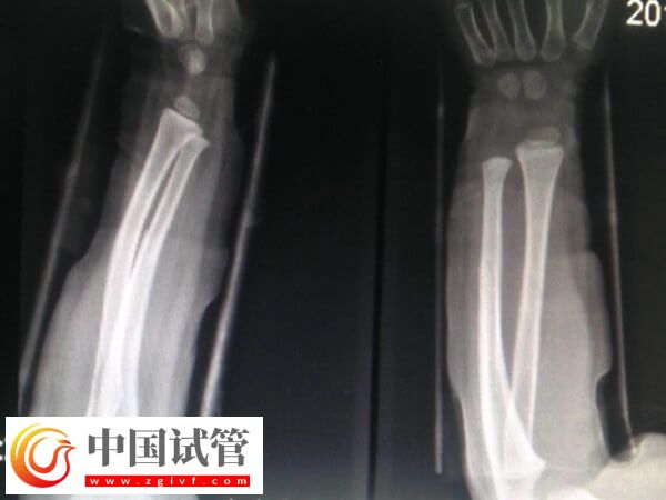 骨折愈合一年可不可以做試管(圖2) 骨折愈合一年可不可以做試管(圖2)