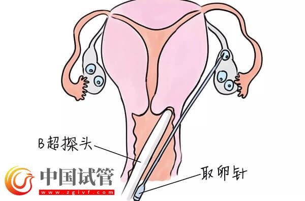 試管嬰兒中用果納芬好不好(圖3) 試管嬰兒中用果納芬好不好(圖3)
