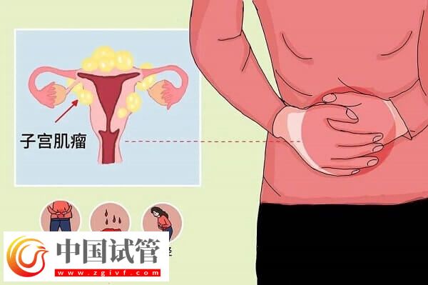 子宮肌瘤是什么原因導致的？專家解讀子宮肌瘤的原因(圖1)